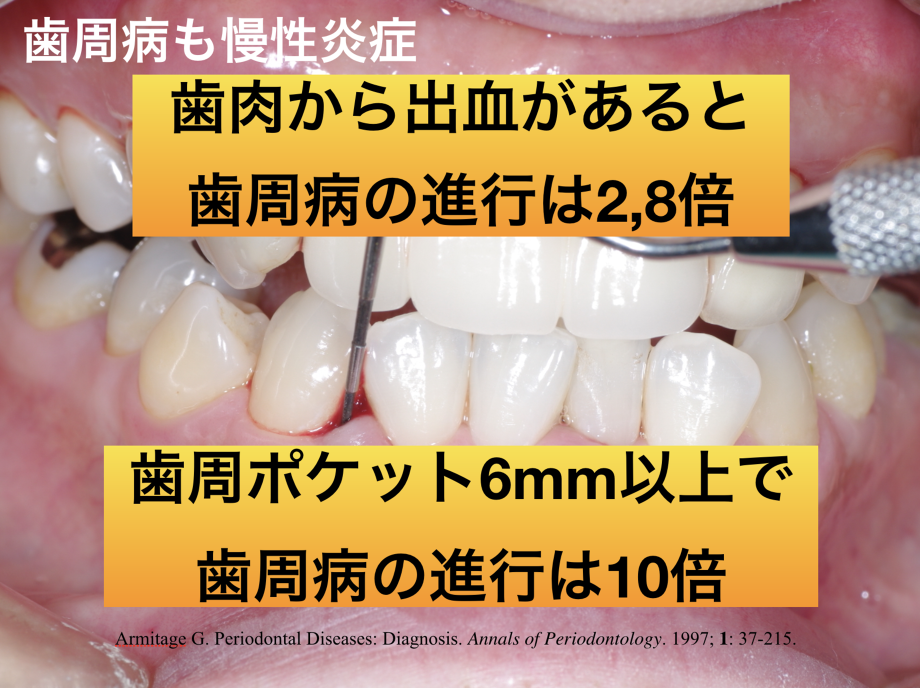 歯肉から出血があると、歯周病の進行は2,8倍に増える。